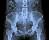 X-Rays More Reliable Than Visual Analysis for Detecting Pelvic Misalignments X-Rays More Reliable Than Visual Analysis for Detecting Pelvic Misalignments